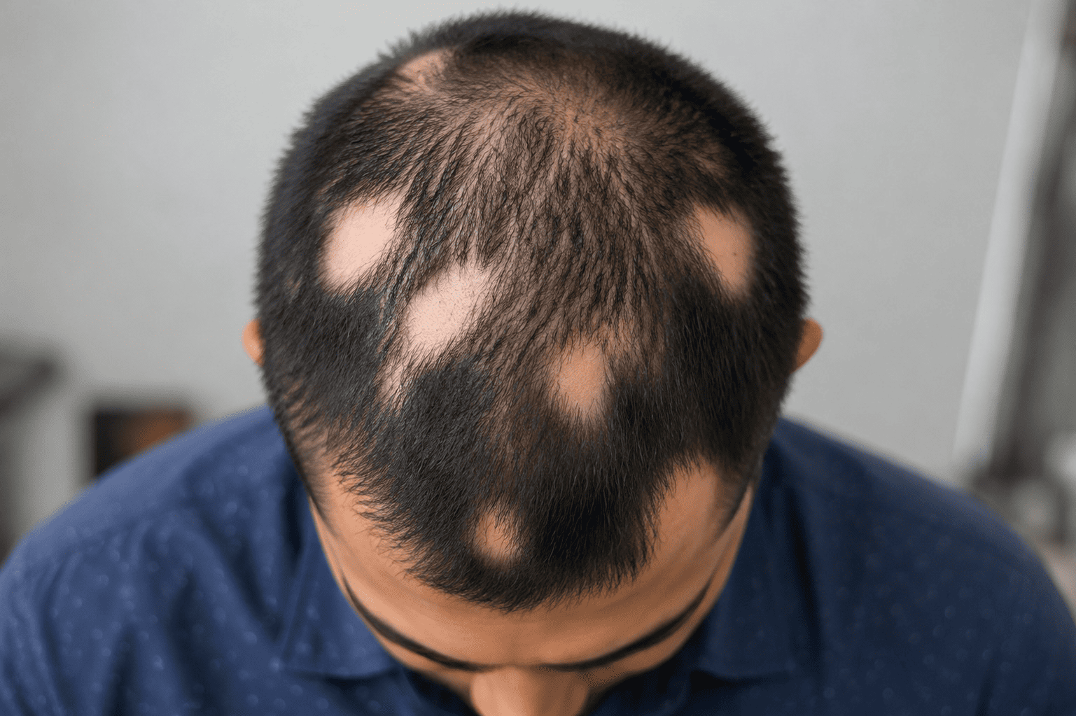 Alopecia Areata Treatment in Chennai
