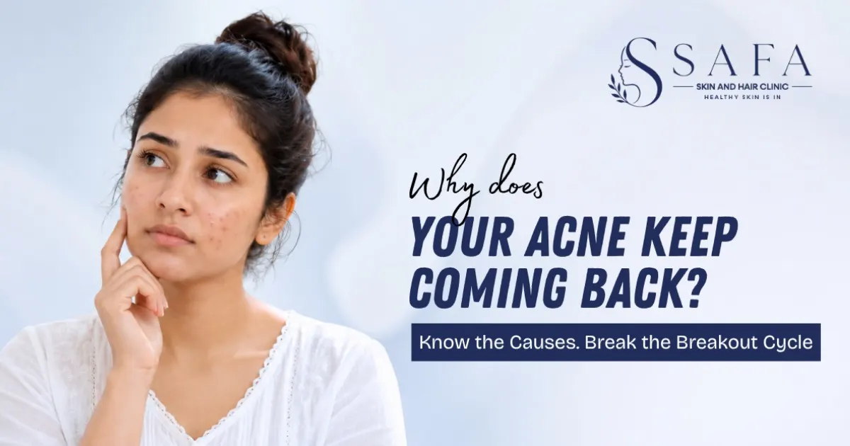 Why Does My Acne Keep Coming Back? 7 Possible Causes and What You Can Do