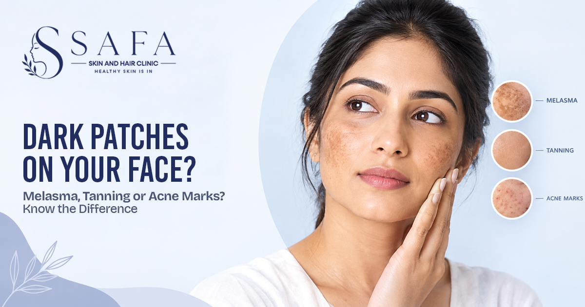 Why Do I Have Dark Patches on My Face? Pigmentation, Melasma or Tanning?